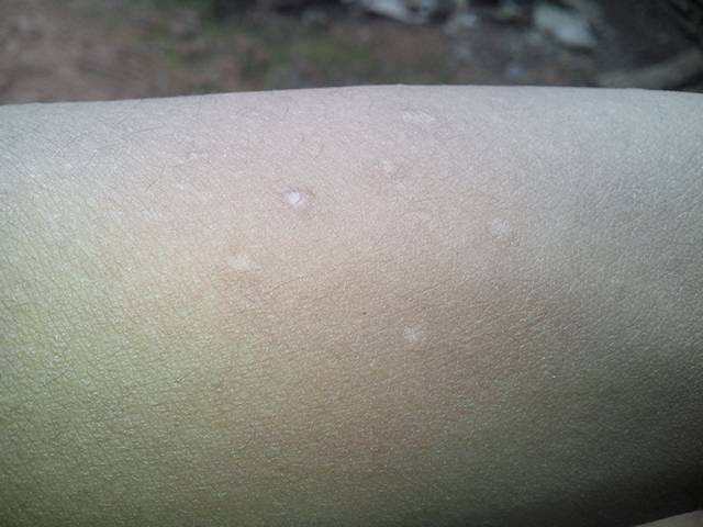 寶寶腿上長白斑是怎么回事